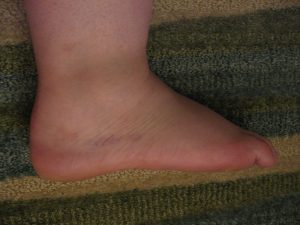 Ankle-Sprain